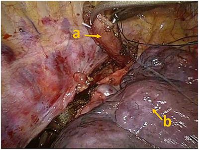 Case Report: Discontinuous Spontaneous Ventilating Anesthesia for McKeown Esophagectomy by Laryngeal Mask: A Case Series—A Novel Approach of Discontinuous Spontaneous Ventilating Anesthesia for Esophagectomy